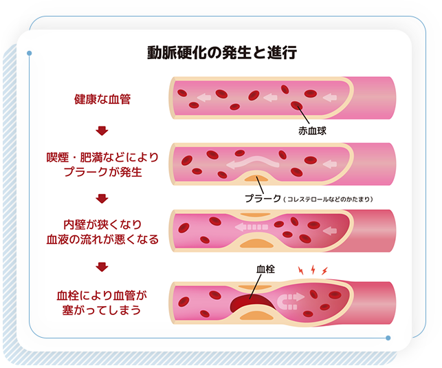 動脈硬化の発生と進行