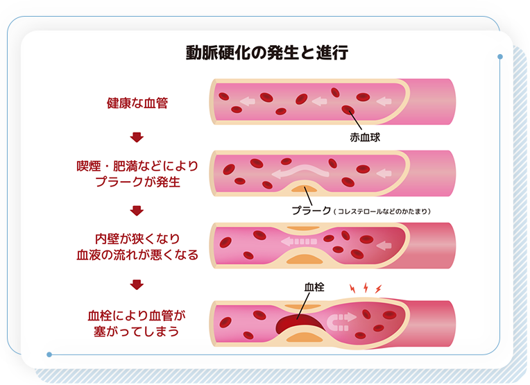 動脈硬化の発生と進行