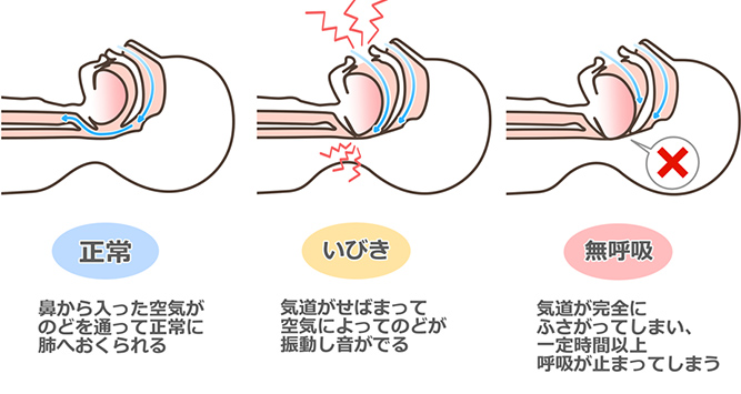 睡眠時無呼吸症候群とは